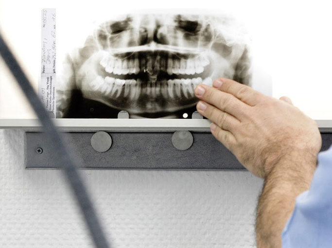 Geschädigter Zahn: Wurzelbehandlung oder Implantat?