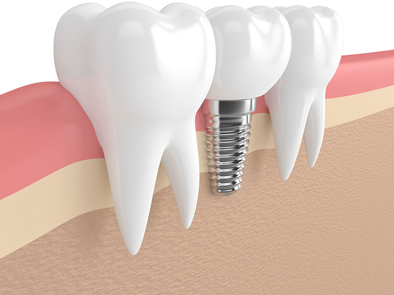 Wir bieten Konzepte für eine optimale Implantat-Versorgung – auch bei Immunerkrankungen!