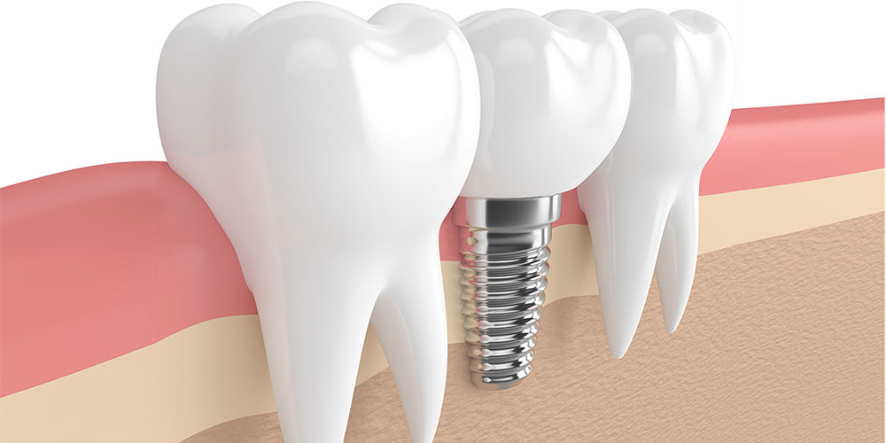 Wir bieten Konzepte für eine optimale Implantat-Versorgung – auch bei Immunerkrankungen!