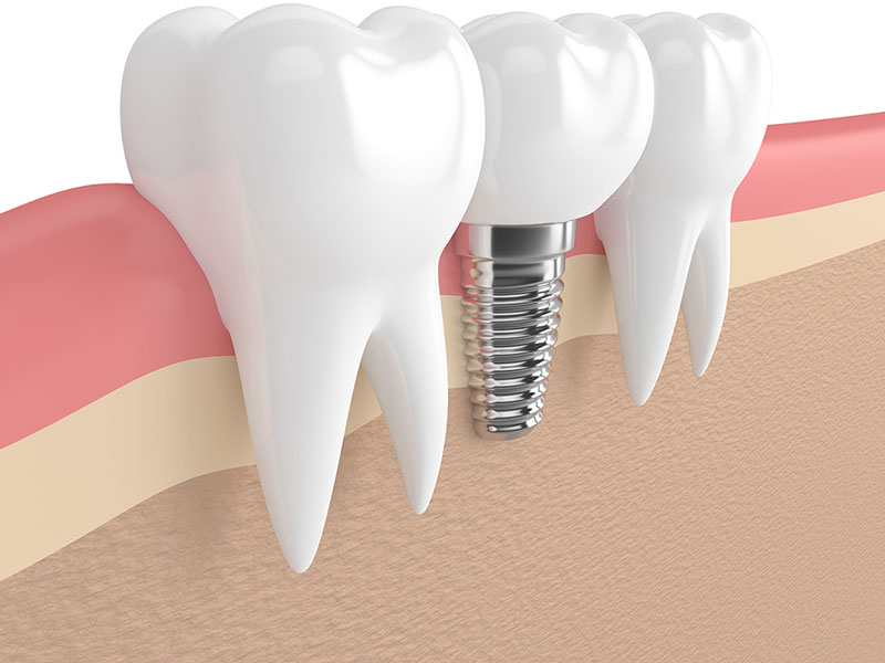 Krankheitsbedingte Zahnlosigkeit: Anspruch auf Implantate!